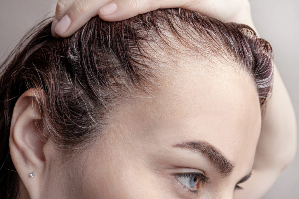 Close-up of woman showing thinning hair along the front hairline.